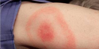 enfermedad de lyme