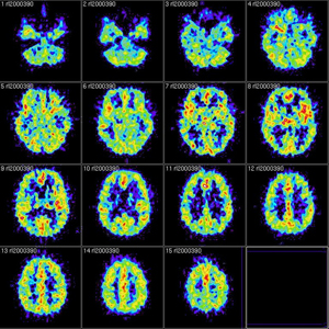 meningitis