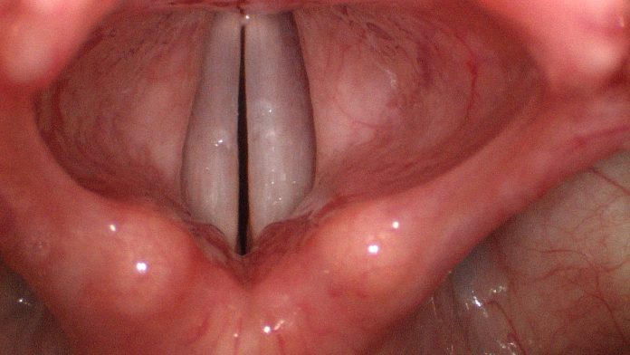 cuerdas vocales inflamadas cuerdas vocales inflamadas