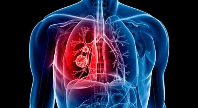 cancer-de-pulmon-etapas-y-sintomas