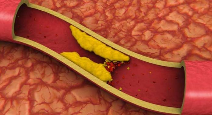 colesterol-alto-y-alimentos-a-evitar