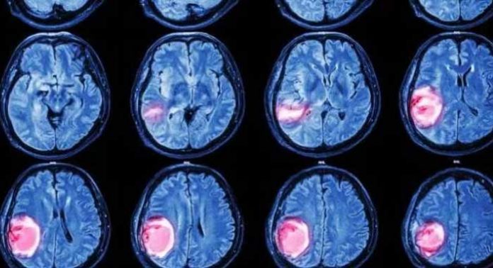 tumor-cerebral-y-enzima-implicada