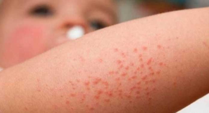 La psoriasis el tratamiento eficaz de la cabeza
