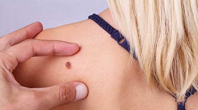 melanoma-y-parkinson